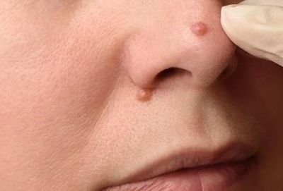 Phát hiện ung thư từ sự thay đổi bất thường ở mặt