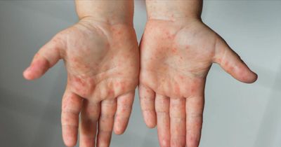 Tay chân miệng gia tăng: Cảnh giác dấu hiệu không điển hình