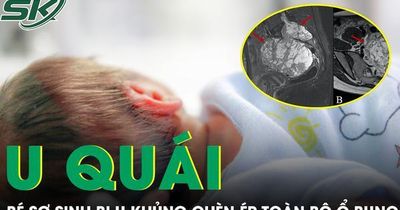 Cứu trẻ sơ sinh 10 ngày tuổi mang khối u hiếm gặp, chèn ép toàn bộ ổ bụng