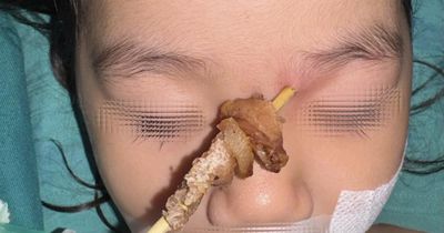 Hy hữu: Bé gái bị que xiên thịt đâm sâu, nguy cơ xuyên sọ não