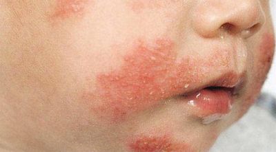 Cảnh báo dị ứng đạm sữa bò