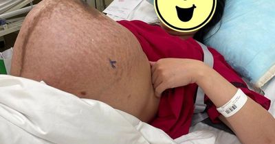 Chiếc bụng mang thai đôi chằng chịt vết rạn, ai nhìn cũng xót xa: 'thở thôi cũng mệt'