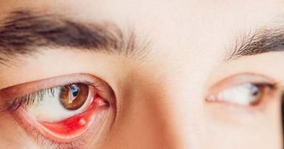 Nguyên nhân gây cộm mắt và cách khắc phục