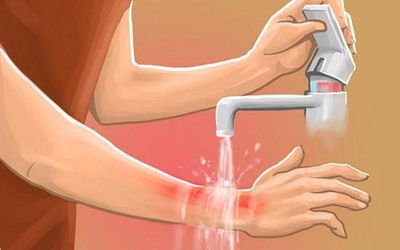 Bỏng nhiệt: Sơ cứu đúng cách để tránh biến chứng
