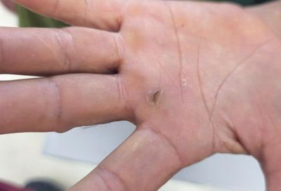 Dồn dập 3 ca tiêm phòng dại nhập viện trong 30 phút