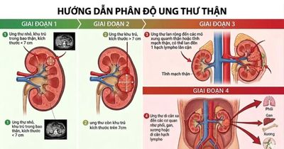 Đau lưng kéo dài, người đàn ông 45 tuổi phát hiện ung thư thận