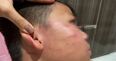 Vụ giáo viên nước ngoài tát học sinh: Gia đình nói bé trai bị thủng màng nhĩ