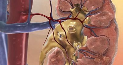 U40 cần biết: Những dấu hiệu cảnh báo suy thận dễ bị bỏ qua