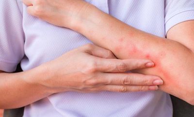 Nắng nóng khiến nguy cơ viêm da gia tăng, phòng ngừa thế nào?