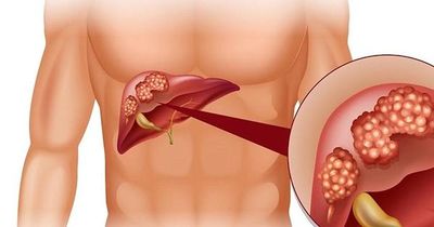 Người mắc viêm gan B sẽ rất nguy hiểm nếu tự ý làm điều này