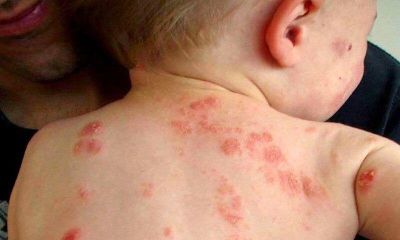Bệnh chốc mùa hè: Nhận biết sớm để tránh biến chứng