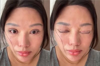 Cắt mí hỏng, người phụ nữ Trung Quốc 6 năm 'sống trong địa ngục'