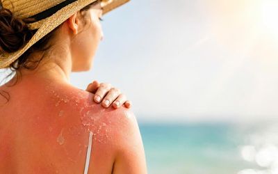 Cháy nắng: Cảnh báo tổn thương da trong mùa nắng nóng