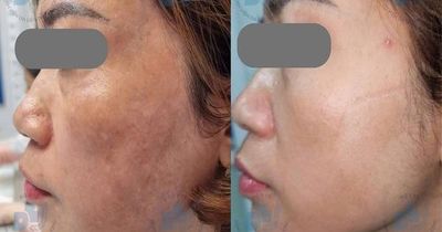 Nám da có nên điều trị bằng laser?