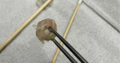 Bé gái 6 tuổi nhập viện khẩn cấp, bố mẹ 'sốc' khi bác sĩ lấy ra thứ 'đáng sợ' từ mũi con