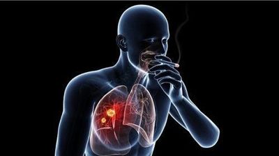 Ung thư đầu cổ có liên quan trực tiếp đến thuốc lá