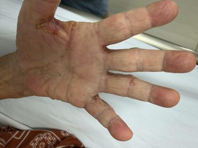 Loài ký sinh trùng tưởng đã 'biến mất' tấn công một gia đình ở Tây Ninh