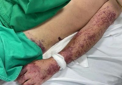 Món khoái khẩu khiến người đàn ông nguy kịch