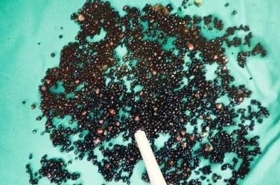 Đau bụng suốt nhiều tháng, người đàn ông 43 tuổi sốc nặng khi bác sĩ gắp ra thứ 'đáng sợ' trong bụng