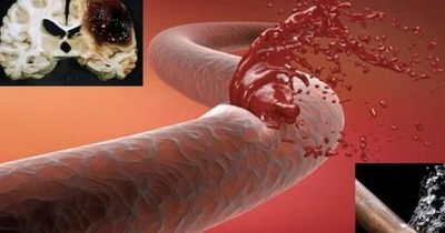 Người đàn ông 43 tuổi xuất huyết não thừa nhận 1 sai lầm nhiều nam giới Việt mắc phải