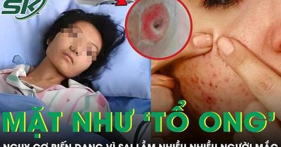 Người phụ nữ chết lặng khi thấy mặt như 'tổ ong', nguy cơ biến dạng vì sai lầm nhiều người mắc