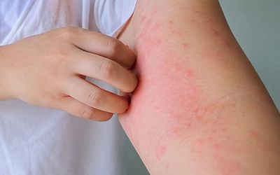 Sử dụng thuốc gì khi nổi mề đay, mẩn ngứa?