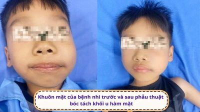 Bóc tách thành công khối u lớn phá hủy xương hàm cho bé trai 7 tuổi