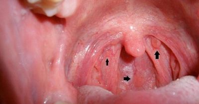 Dấu hiệu nhận biết sớm ung thư vòm họng hiệu quả
