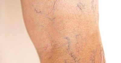 8 cách giúp cải thiện bệnh suy giãn tĩnh mạch tại nhà