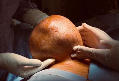 Chịu đựng vòng một nặng 3,5 kg, người phụ nữ phải phẫu thuật gấp