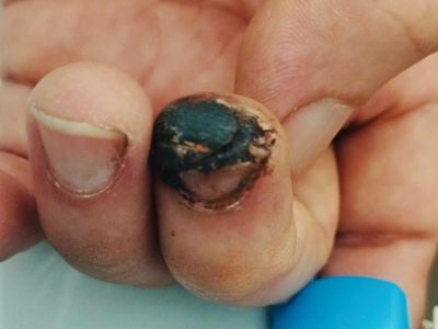 Bị thương do cành cây đâm, người bệnh ra đi trong tiếc nuối