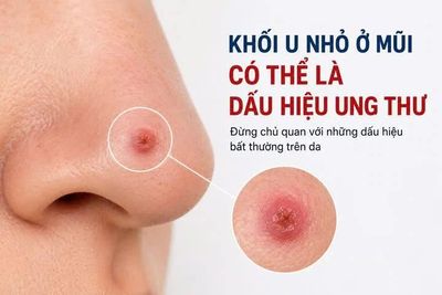 Phát hiện sớm ung thư da từ mụn nhỏ trên mũi