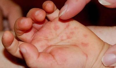 Cà Mau ghi nhận trên 1400 ca mắc bệnh tay chân miệng