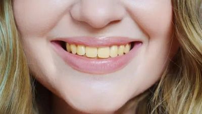 Chuyên gia chỉ ra 4 thực phẩm làm răng ố vàng, đánh mãi vẫn không trắng