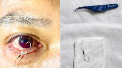 Cấp cứu thành công cho người đàn ông bị lưỡi câu móc vào mắt khi đi câu cá