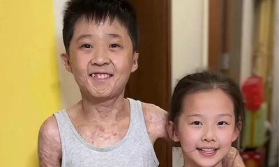 Cậu bé bỏng 97% cơ thể và giấc mơ thành nhà vô địch cầu lông