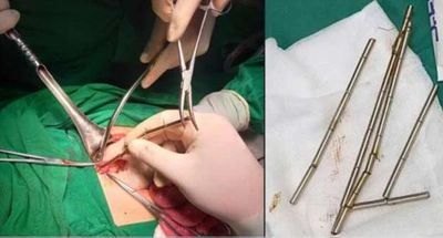 Phẫu thuật lấy 25 viên nam châm trong đường tiêu hóa bệnh nhi
