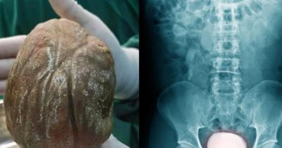 Đau đớn mang 'khối đá' 1,3kg trong cơ thể suốt nhiều năm vì ngại đi khám