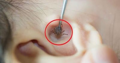 Bé 2 tuổi đau tai bất thường, bố mẹ 'sốc' khi bác sĩ gắp ra thứ 'đáng sợ' bên trong