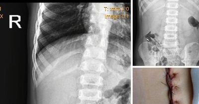 Xôn xao việc bác sĩ phẫu thuật lấy dị vật cho một bệnh nhi ở Nghệ An