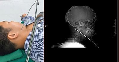 Nam thanh niên đi bắn cá bị mũi tên bật ngược đâm xuyên sâu 15cm vào vùng mặt