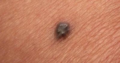 Người đàn ông suýt chết vì... một nốt ruồi