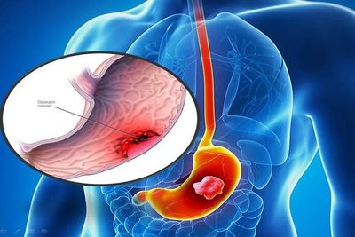 Hướng đi nào trước gánh nặng ung thư đường tiêu hóa tại Việt Nam?