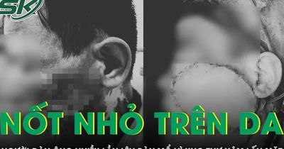 Chủ quan với nốt nhỏ trên da, người đàn ông nhiều lần phẫu thuật ung thư xâm lấn tái phát