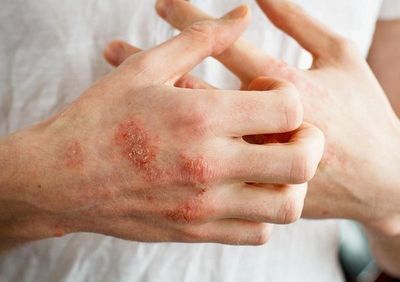 Căn bệnh không lây bùng phát dữ dội, gây 'bão viêm' toàn thân