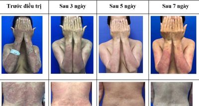 Điều trị thành công ca vảy nến thể mủ toàn thân nặng bằng thuốc sinh học mới