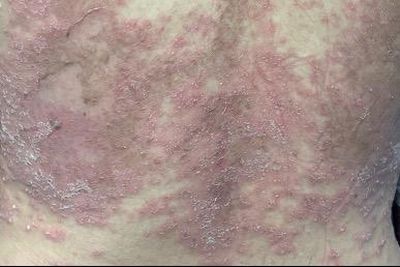 Cảnh giác với căn bệnh không lây nhưng nguy hiểm