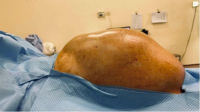 Phẫu thuật khối u buồng trứng gần 15kg cho nữ sinh 16 tuổi