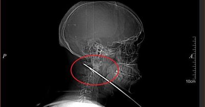 Nhập viện vì đau bất thường, nam bệnh nhân 27 tuổi khiến bác sĩ 'sốc' khi lấy ra thứ không ngờ tới