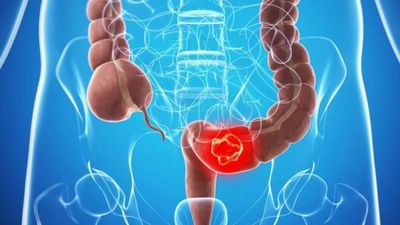 Từ polyp đến ung thư: Hành trình 10 năm có thể ngăn chặn
